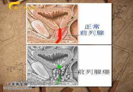 前列腺癌的病发原因是什么