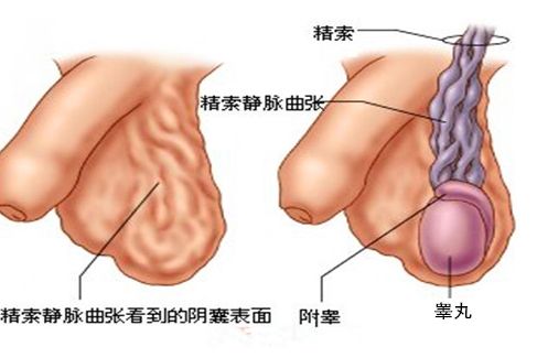 精索静脉曲张怎么治疗