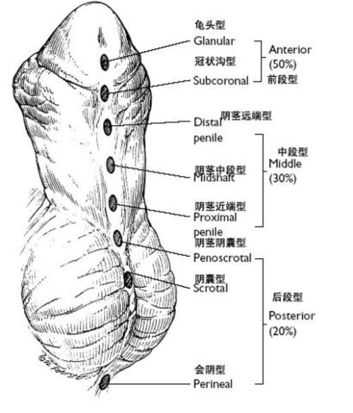尿道下裂的临床表现有哪些