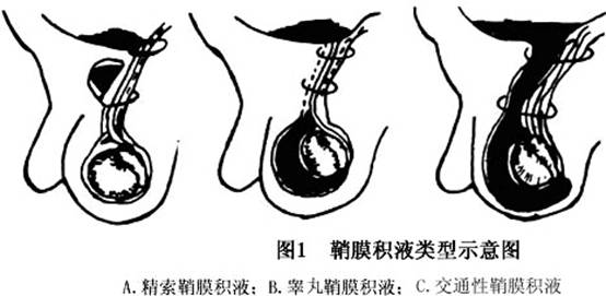 鞘膜积液的危害有哪些