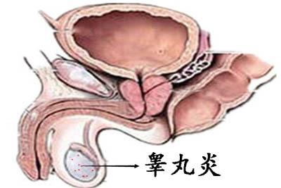 睾丸炎的临床表现有哪些