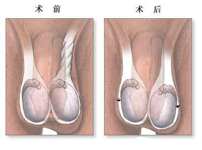 鞘膜积液的临床表现