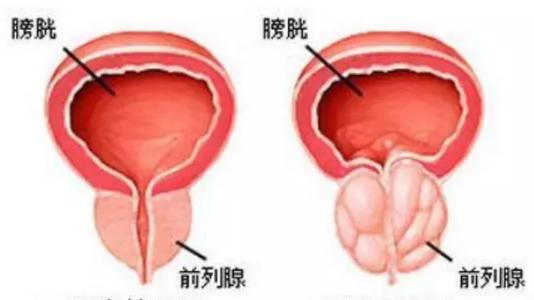 如何治疗前列腺增生