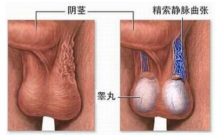 精索静脉曲张的临床表现