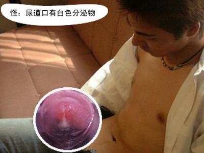 尿道炎的临床表现是什么