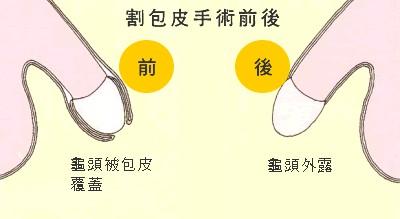 包皮过长的影响